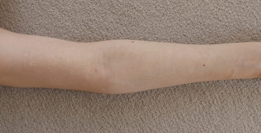 self harm scars after skin graft surgery