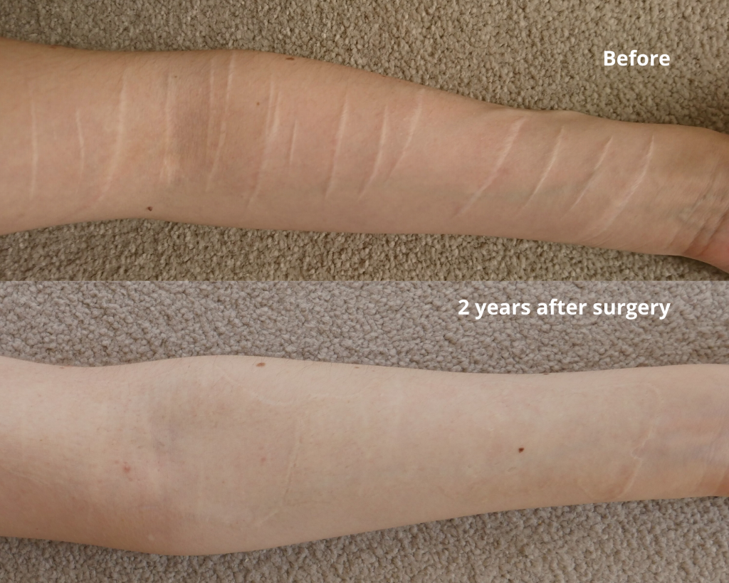 skin graft surgery for self harm scars