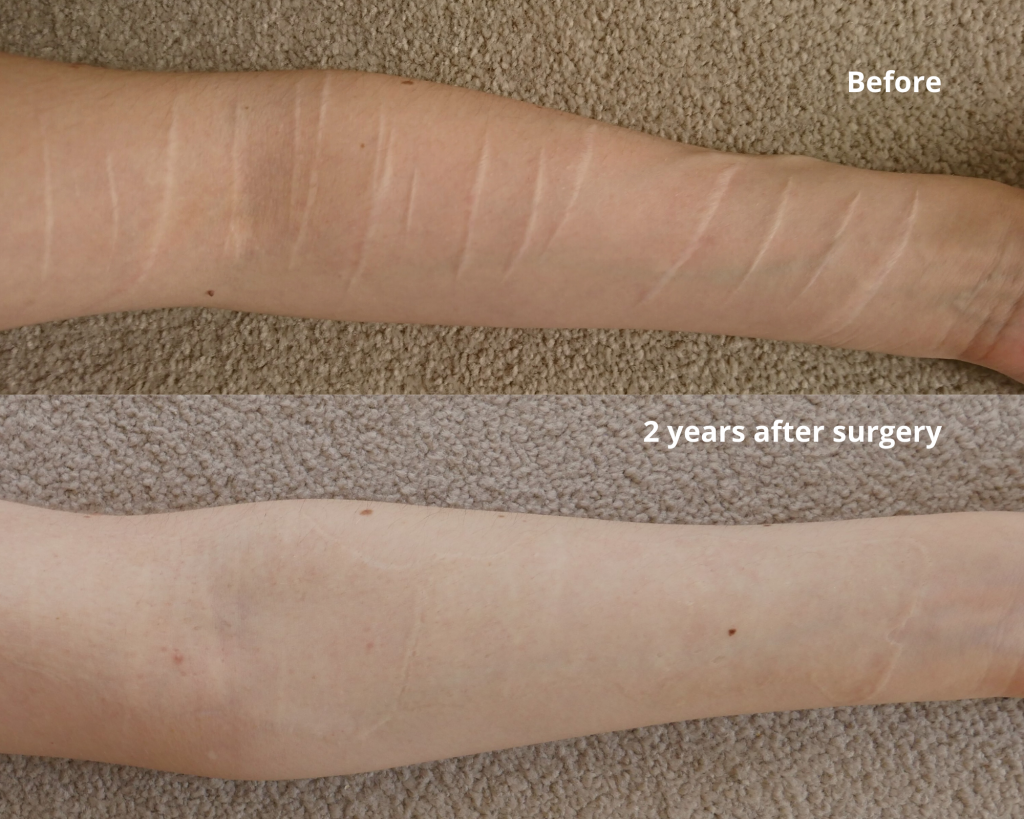 Skin Graft Surgery Process At Karen Evans Blog